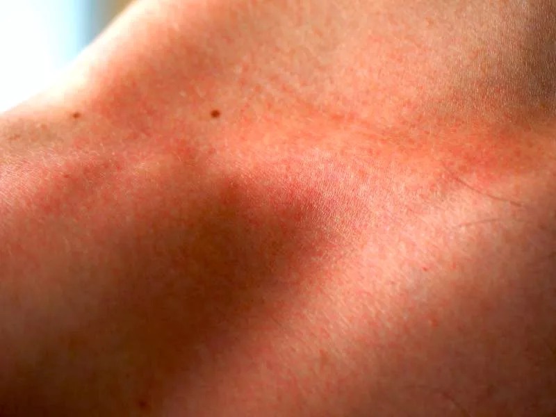 Червоні плями на шкірі як симптом панкреатиту
